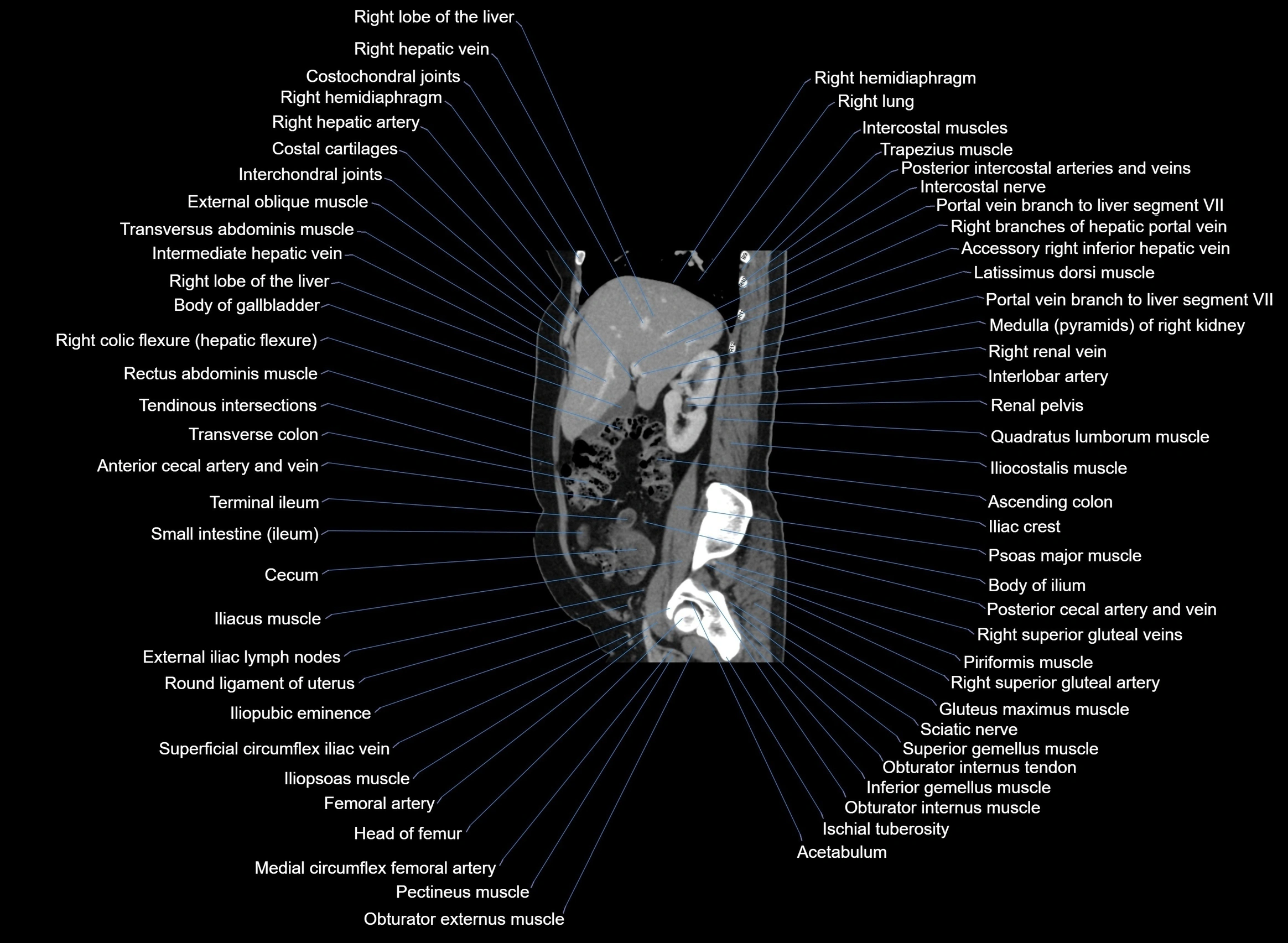 CT Abdomen sagittal cross sectional anatomy labelled radiology image -00079.webp